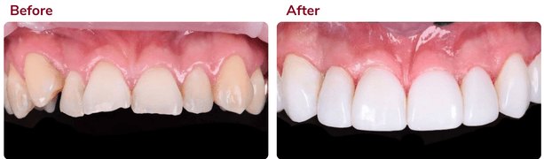 Before and after composite bonding 1