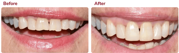 Before and after composite bonding 2