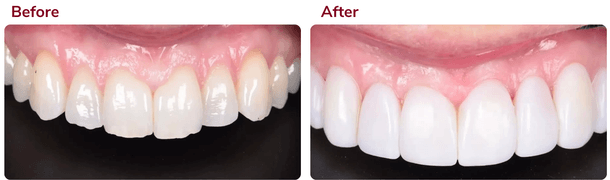 Before and after composite bonding 3